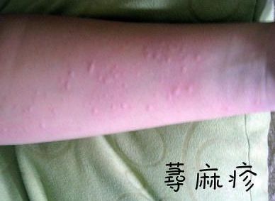 荨麻疹的病因有什么