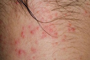 湿疹的症状特点