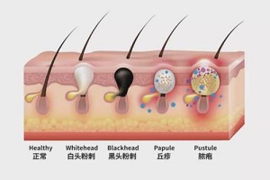 痤疮不同程度的不同症状