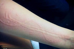 荨麻疹怎样预防好